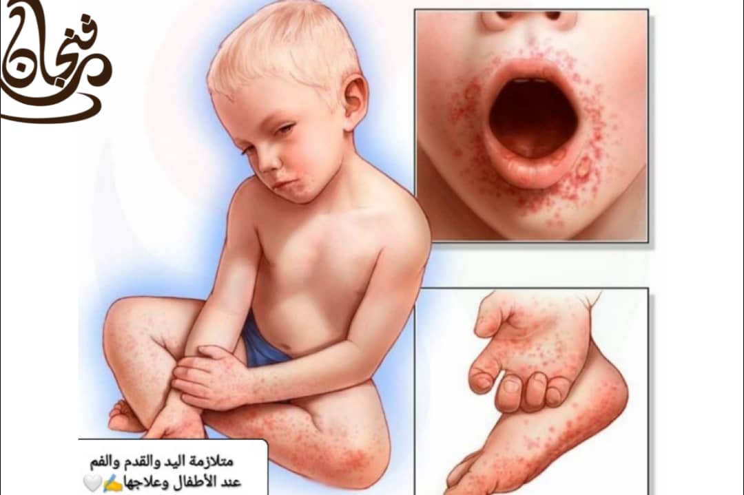 متلازمة اليد والقدم والفم عندَ الأطفال وعلاجها