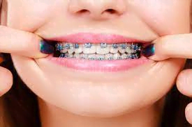 فوائد تقويم الأسنان وأضراره