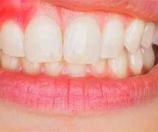 الفرق بين ألم التهاب العصب وألم حساسية الأسنان
