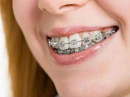 ما هو تقويم الأسنان الوقائي