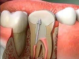 التهاب عصب الأسنان - الأسباب، الأعراض والعلاج