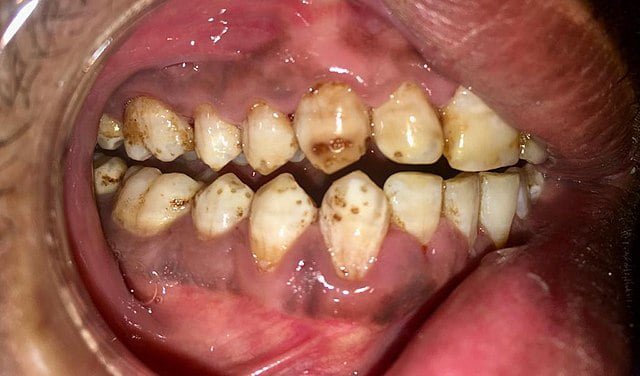 تسمم الأسنان بالفلورايد الأسباب والأعراض وطرق العلاج