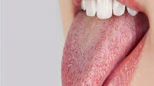 جفاف الفم.. الأعراض، الأسباب والعلاج