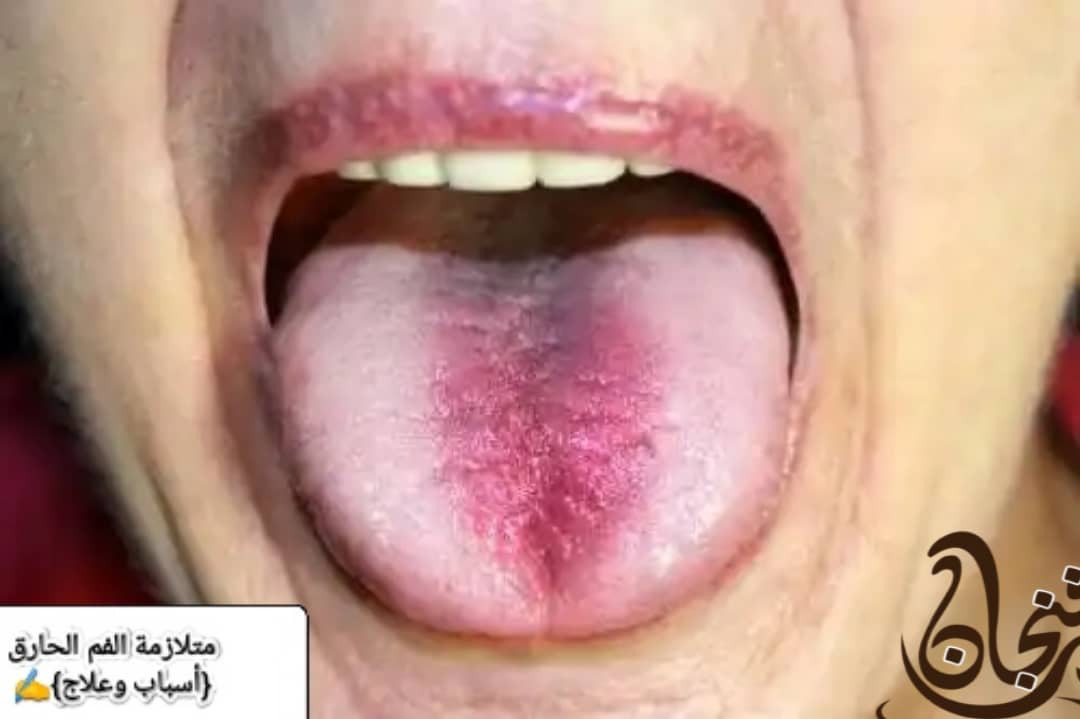 متلازمة الفم الحارق
