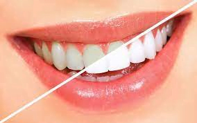 تبييض الأسنان وأساليبه المختلفة