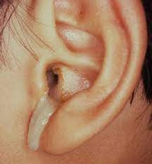 أسباب خروج قيح من الأذن