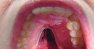 التهاب سقف الفم