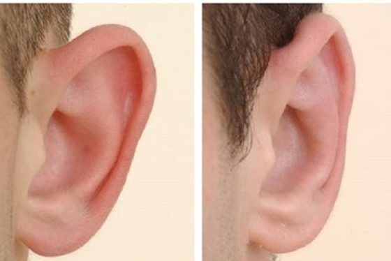 أسئلة شائعة عن تجميل الأذن