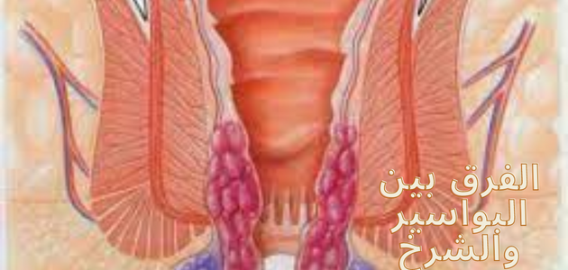 الفرق بين البواسير والشرخ The difference between hemorrhoids and fissures