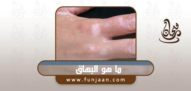 يدي عليها بقع بسبب الاصابة بمرض البهاق، ما هو البهاق (What is vitiligo).