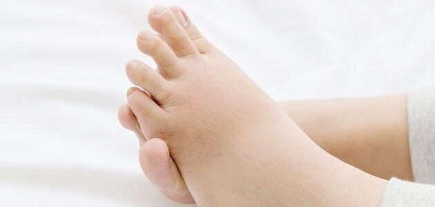 تورم القدمين عند الحامل Swollen feet during pregnancy