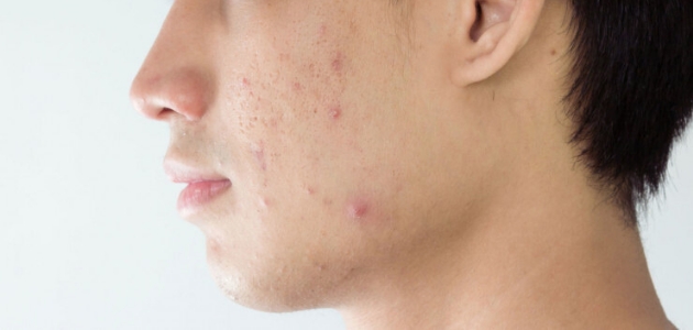 علاج حبوب الوجه؛ حبوب الوجه تظهر على وجه شاب بشكل جانبي.