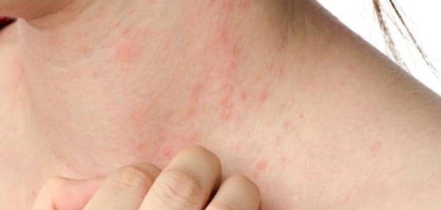 اعراض القوباء الجلدية Symptoms of skin impetigo