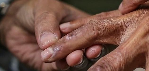 علاج مرض الجذامTreatment of leprosy