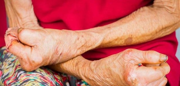 ما هو مرض الجذام What is leprosy?