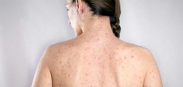 الامراض المنقولة بالجنس Sexually transmitted diseases