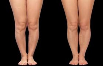 علاج تقوس الساقين